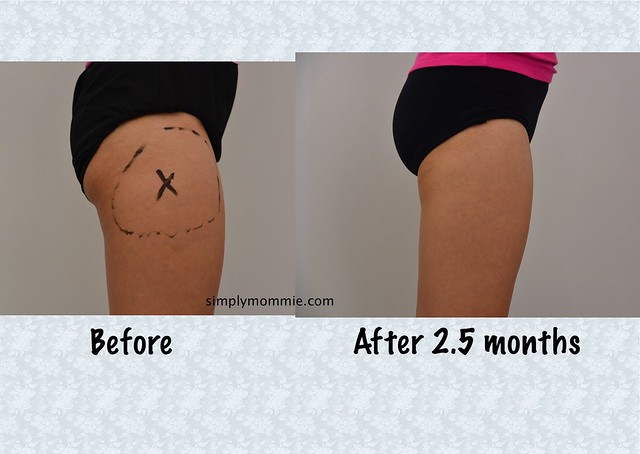 CoolSculpting Thighs