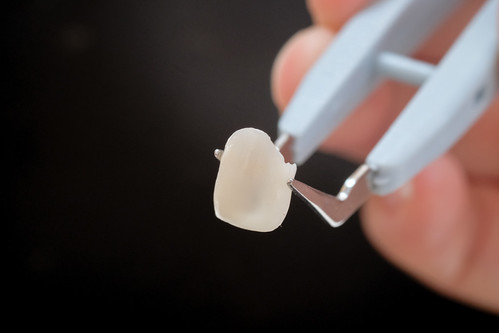 [推薦] 台南佳美牙醫陶瓷美白貼片拯救了天生牙齒黃的我 (2)