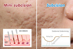 Subcision®